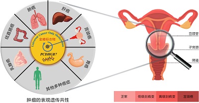 全癌標(biāo)志物可以將宮頸癌的篩查提前到高級別瘤變階段